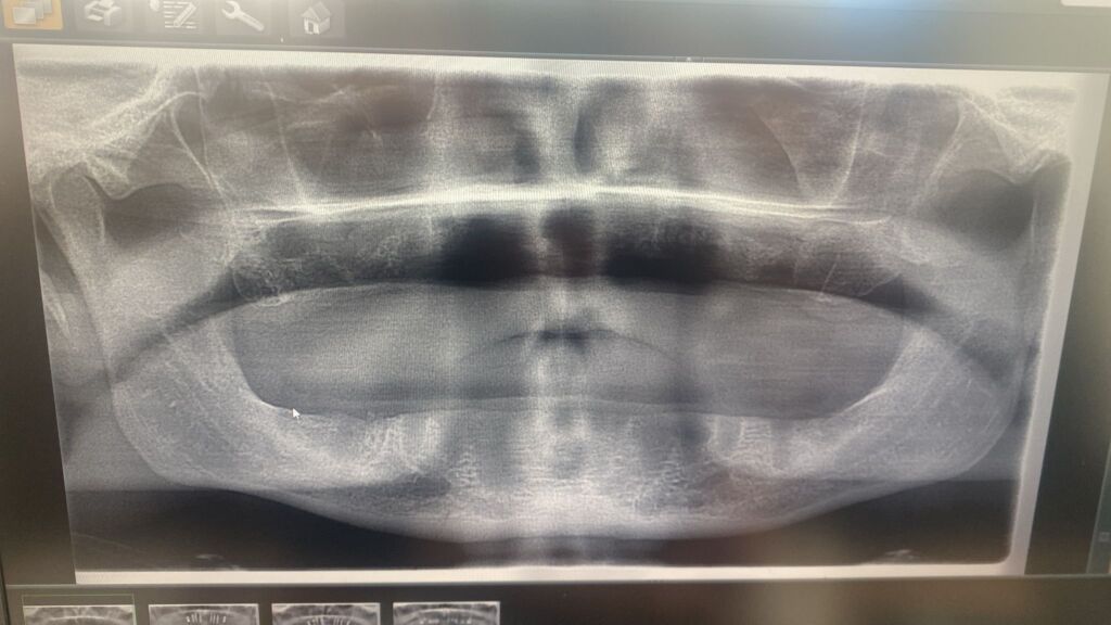 Een r&ouml;ntgenfoto van zijn mond waar je ziet dat Jon Denton geen tanden meer heeft.