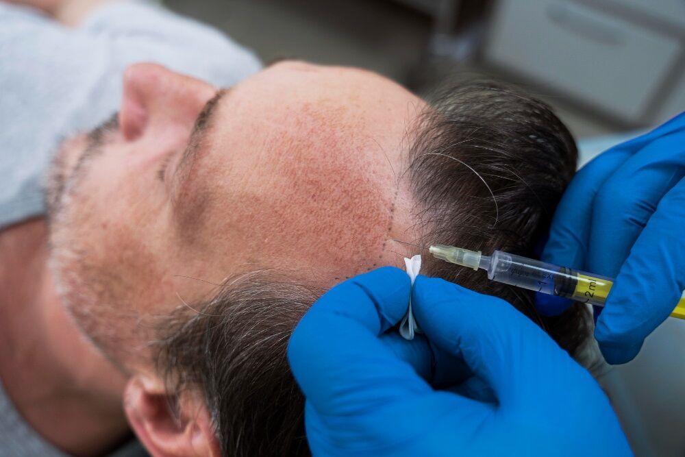 gemiddelde kosten haartransplantatie heren