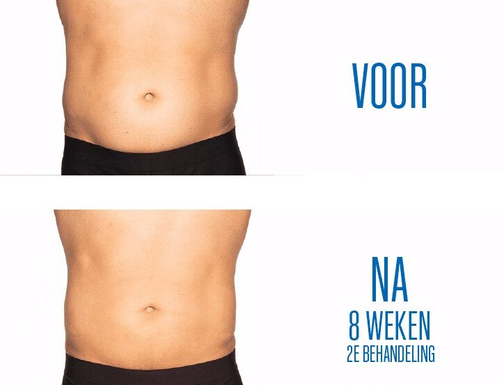 man buik resultaat coolsculpting foto's