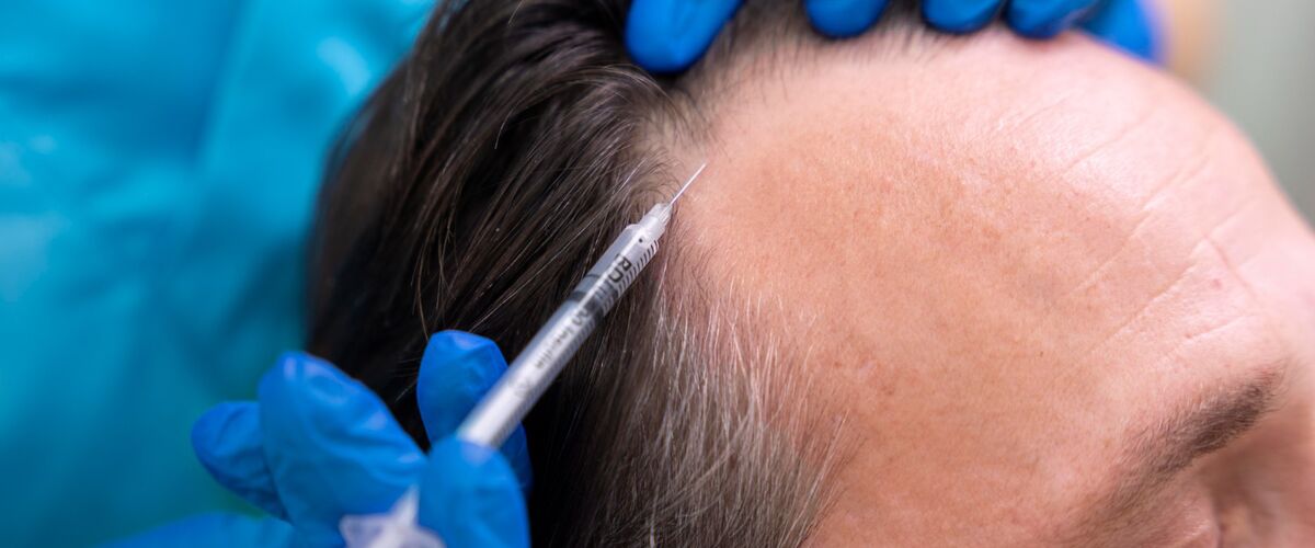 Hoe duur is een haartransplantatie voor mannen?