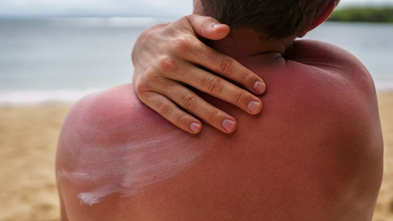 wanneer gebtuik je welke factor zonnebrand spf