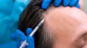 hoe duur haartransplantatie gemiddeld mannen