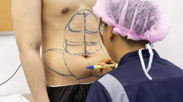 sixpack gespierd plastische chirurgie