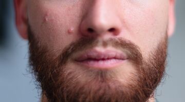 acne slechte huid eiwitshakes