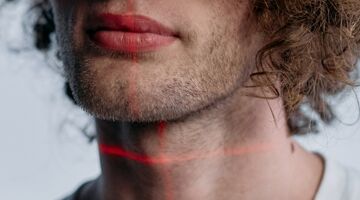 waar haren weg laten laseren man