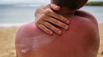 wanneer gebtuik je welke factor zonnebrand spf