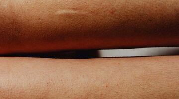 Dit is hoe je littekens het best kunt behandelen en minder zichtbaar maakt