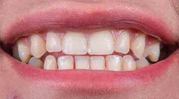 Gebit van een man die last heeft van zijn tanden