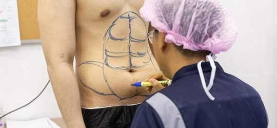 sixpack gespierd plastische chirurgie