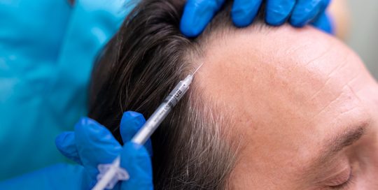 hoe duur haartransplantatie gemiddeld mannen