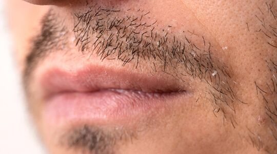 droge gebarsten lippen