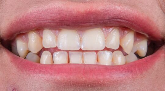 Gebit van een man die last heeft van zijn tanden